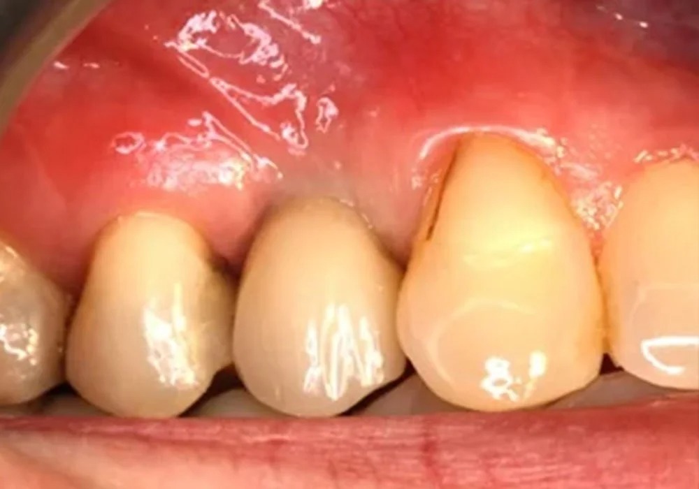 After treatment