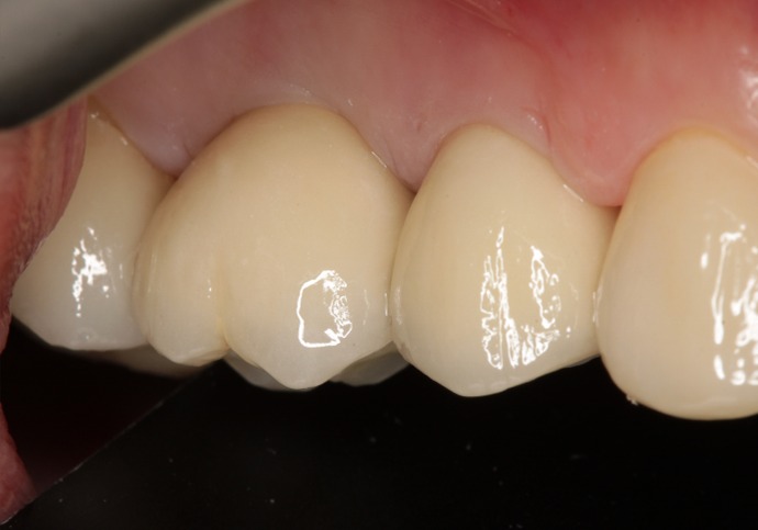 After treatment