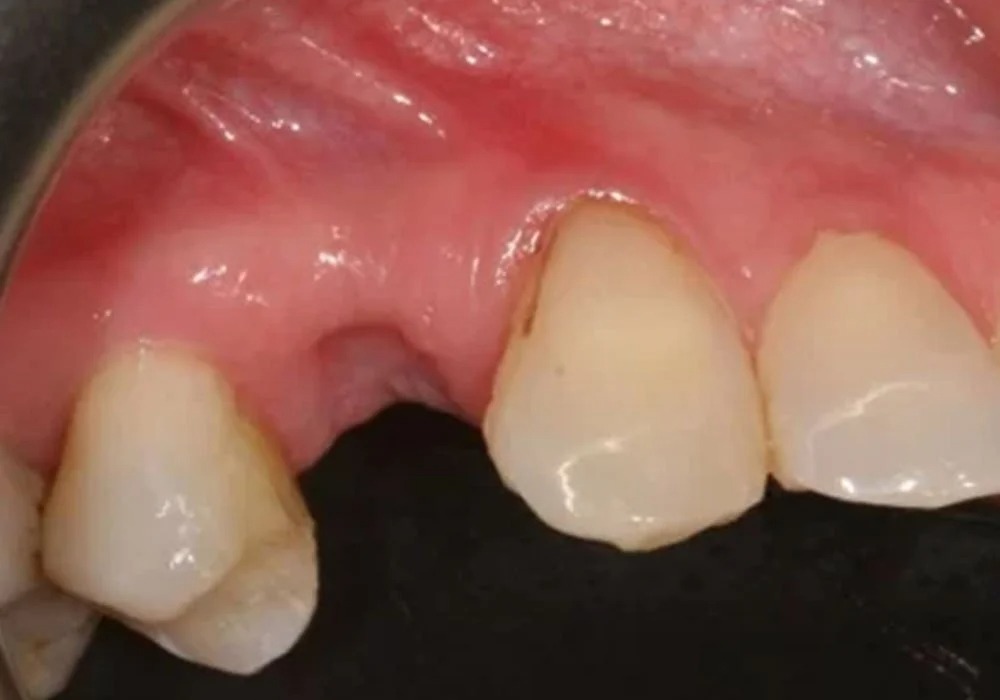 Before treatment