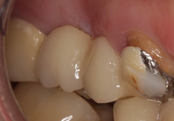 Before treatment
