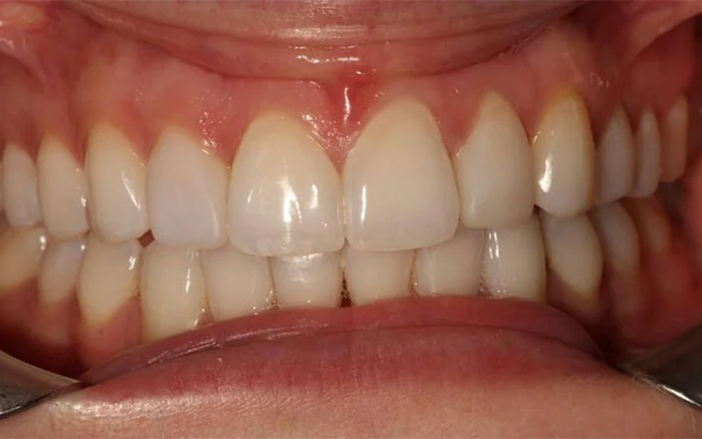 After treatment