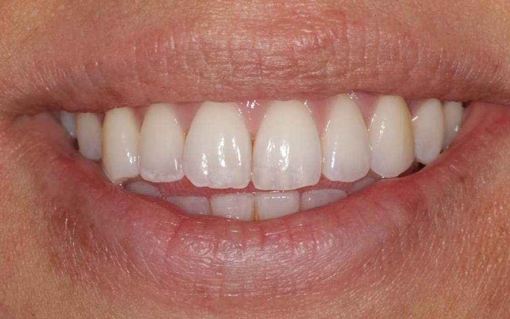 After treatment