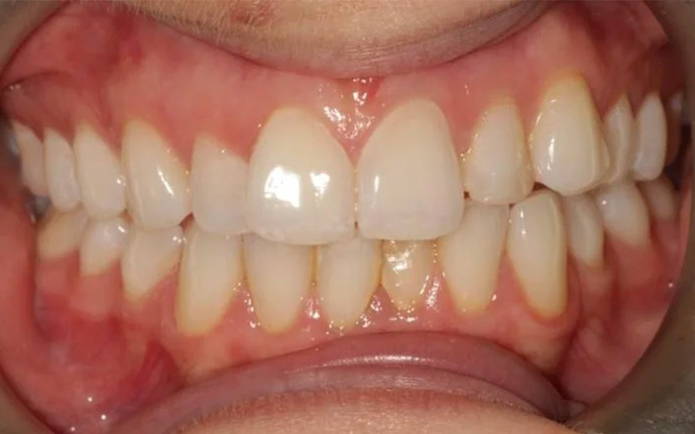 Before treatment