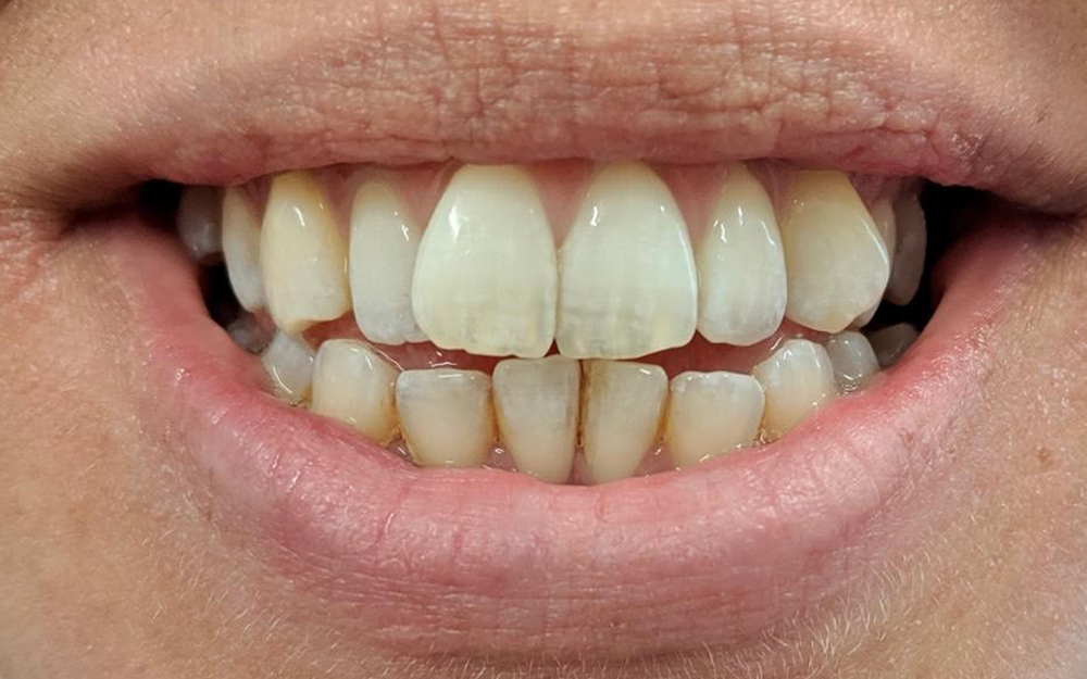 Before treatment